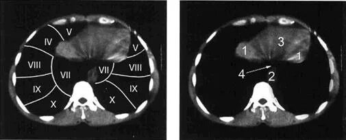 Кт 4 легкие. Сегменты легких кт Radiology 24. Сегменты легких кт анатомия. Сегментарное строение лёгких кт. Сегментарное строение легких на кт.