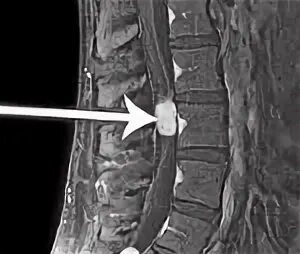 Эпендимома спинного. Эпендимома конского хвоста спинного мозга. Эпендимома спинного мозга симптомы. Эпендимома мрт позвоночника.