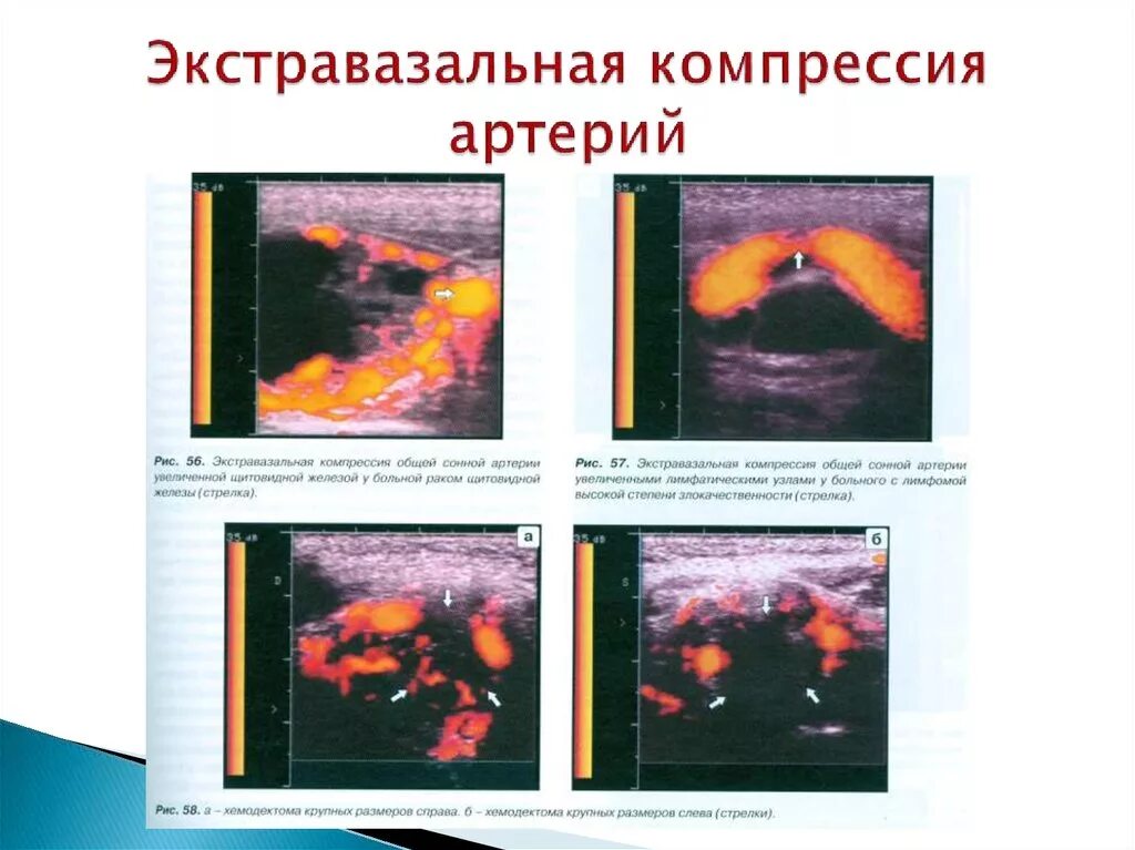 Шейный остеохондроз синдром позвоночной артерии. Синдром позвоночной артерии вертебро-базилярная недостаточность. Артерии позвоночника. Признаки компрессии позвоночных артерий. Синдром позвоночнойьартерии.