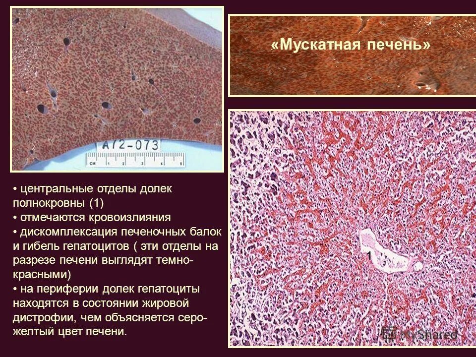 Печень при хроническом венозном застое. Мускатная печень патанатомия макропрепарат. Мускатная печень патанатомия этиология. Препарат венозное полнокровие печени мускатная печень. Мускатная печень микропрепарат патанатомия.