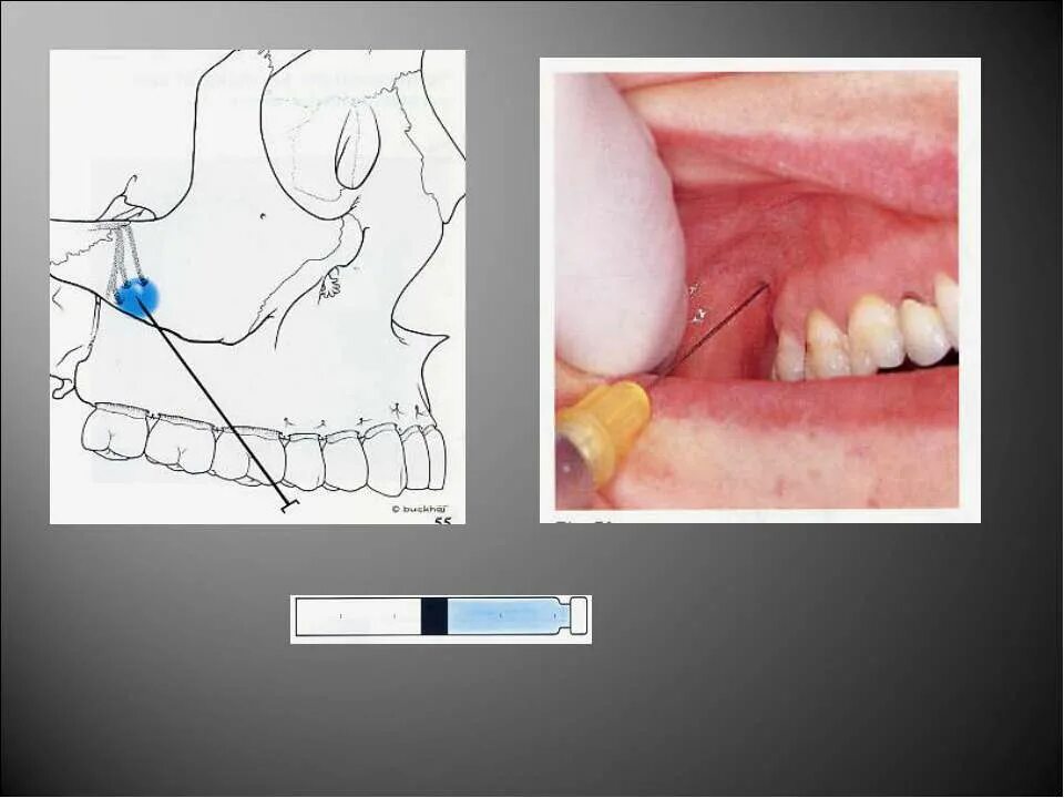 Туберальная анестезия верхней челюсти. Туберальная проводниковая анестезия. Туберальная анестезия зона. Туберальная анестезия внутриротовая. Проведение проводниковой анестезии
