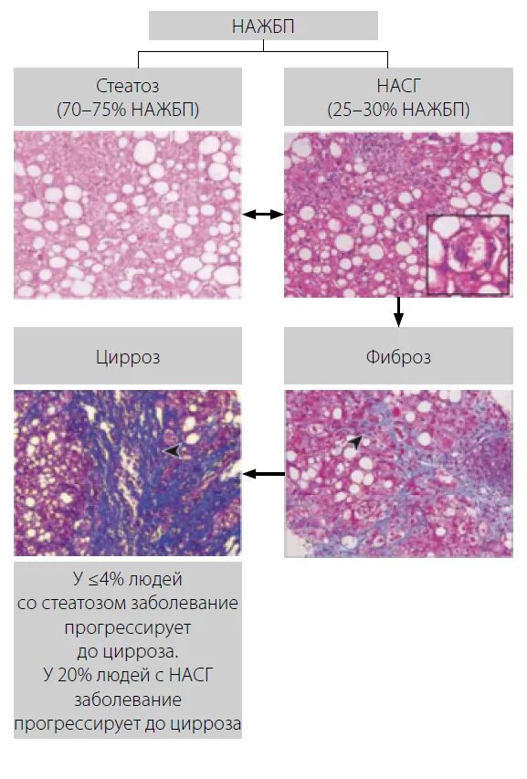 Признаки стеатоза печени. Алкогольная жировая болезнь печени гистология. Неалкогольная жировая болезнь печени гистология. Гистологические стадии фиброза печени.