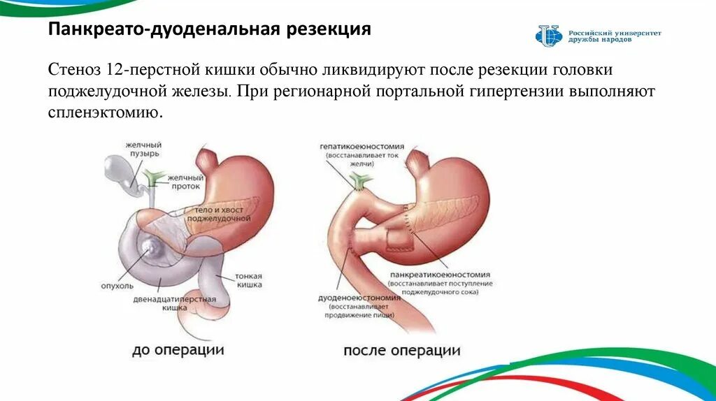 Операция Бегера на поджелудочной железе. Резекция головки поджелудочной. Панкреато дуоденальная резекция. Операция по Фрею на поджелудочной железе.