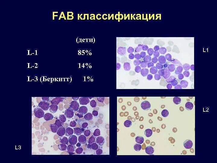 Лимфобластный лейкоз у взрослых. Острый лимфобластный лейкоз l1. Острый лимфобластный лейкоз b 1 вариант. Лимфобластные лейкозы классификация. Острый лимфобластный лейкоз клиника.