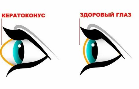 Кератоконус что