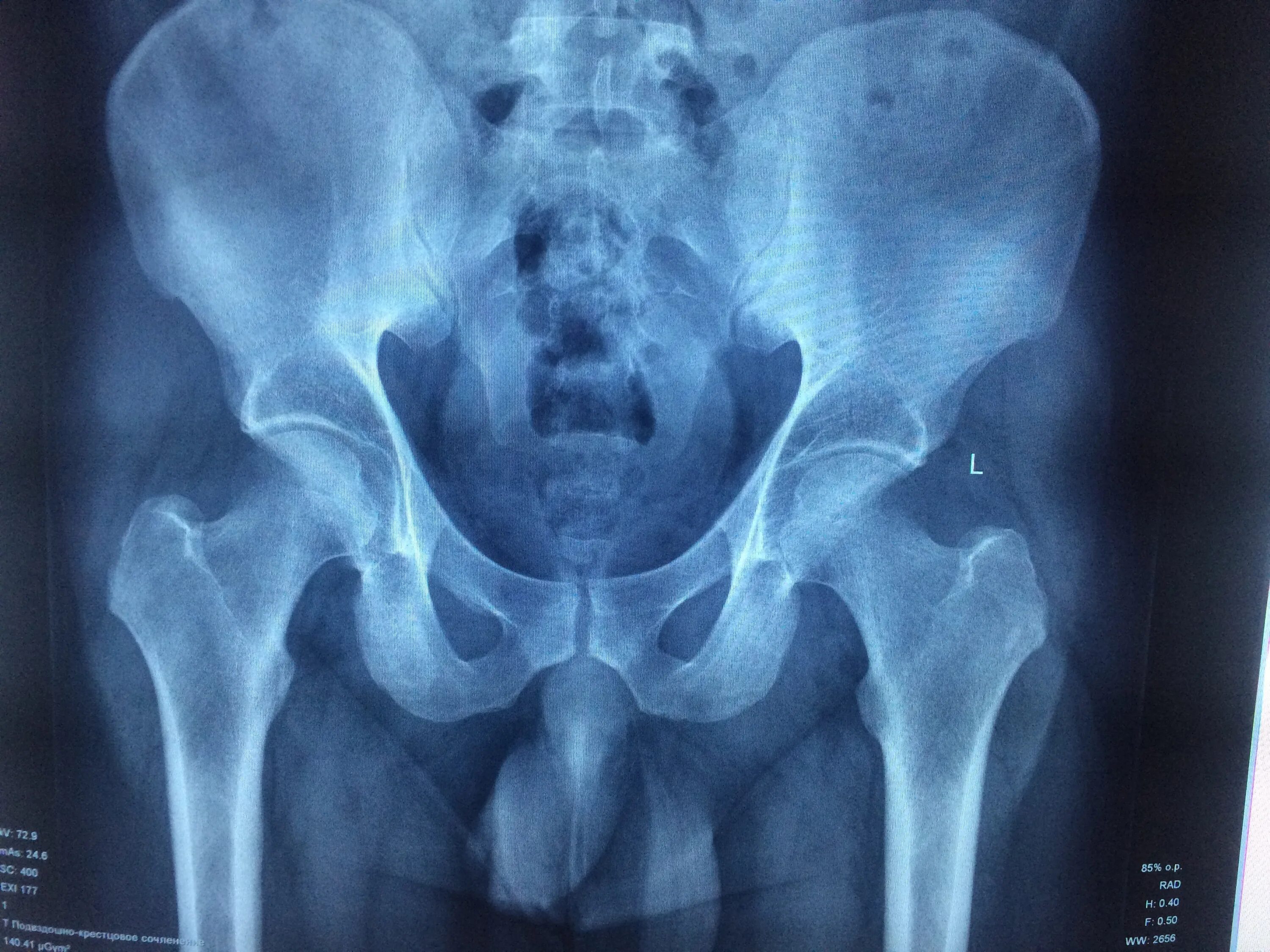 Рентген можно сделать. Рентген костей таза норма. Кости таза рентген норма. Рентген костей таза тазобедренных суставов цифровой. Обзорная рентгенография костей таза.