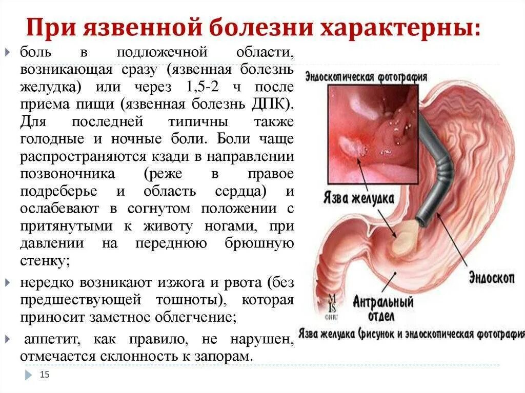 Язвенная болезнь желудка и 12 перстной кишки. Проявления язвенной болезни желудка и 12-перстной кишки.. Язвенная болезнь 12 перстной кишки симптомы. Терапия язвенной болезни 12 перстной кишки.