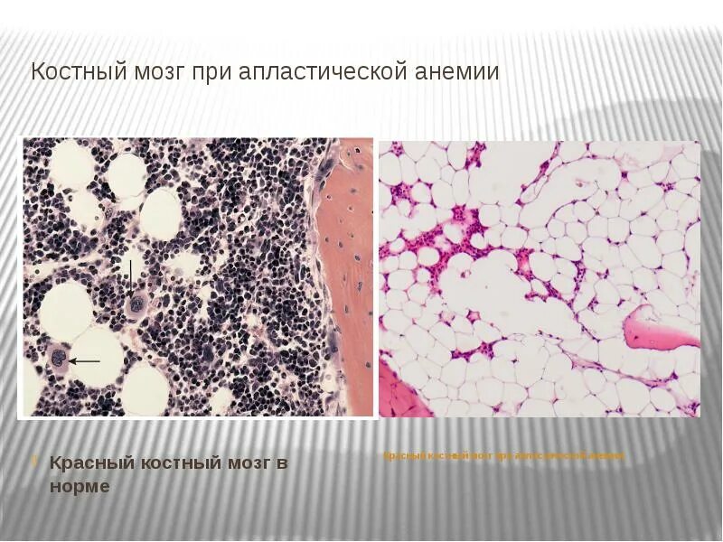 Картина крови при апластическая анемия. Апластическая анемия костный мозг. Апластическая анемия миелограмма. Апластическая анемия микропрепарат. Костный мозг при гипопластической анемии.