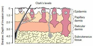Меланома по Кларку и Бреслоу. Уровни инвазии меланомы по Кларку. Меланома инвазия по Кларку 3. Меланома 1 инвазии по Кларку. Степень инвазии