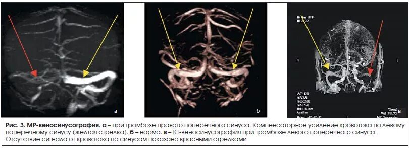 Тромбоз поперечного синуса головного мозга на кт. Тромбоз поперечного сигмовидного синуса мрт. Тромбоз поперечного синуса кт. Тромбоз поперечного синуса головного. Мрт тромбоз