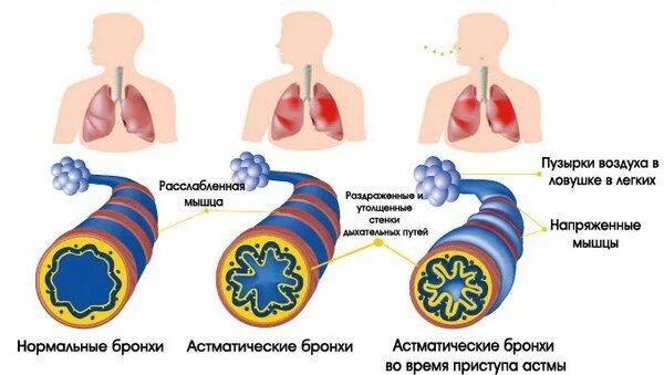 Почему ба. Изменение бронхов при бронхиальной астме. Обструкция дыхательных путей бронхиальная астма. Период обратного развития бронхиальной астмы. Легкий приступ бронхиальной астмы.