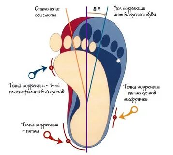 Ортопедическая деформация стопы