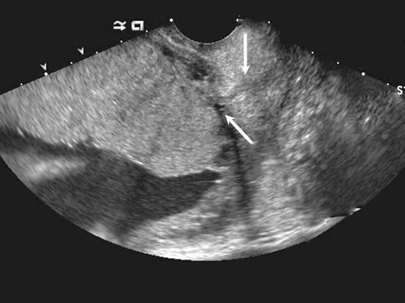 Врастание плаценты в рубец на матке УЗИ. Эхография отслойки плаценты. Плацента на рубце матки