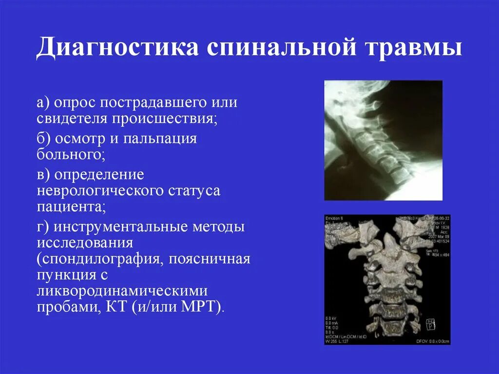 Сотрясение позвоночника. Диагностика повреждений позвоночника. Позвоночно-спинномозговая травма диагностика. Травма позвоночника диагноз. Методы диагностики повреждения позвоночника.