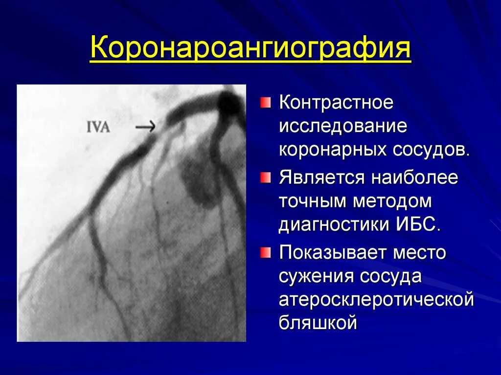 Расширяет коронарные сосуды. Коронарография атеросклероз сосудов. Коронарография стеноз. Коронарные сосуды коронарография. Ангиография коронарных артерий.