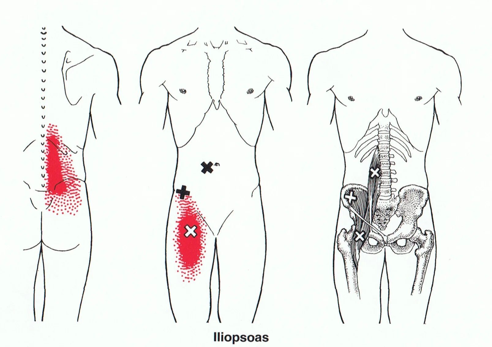 Боль поясница слева отдает в ногу. Подвздошно-поясничная мышца триггерные точки. Триггерные точки в мышцах спины. Триггерные точки в области поясницы. Триггерные точки ППМ.