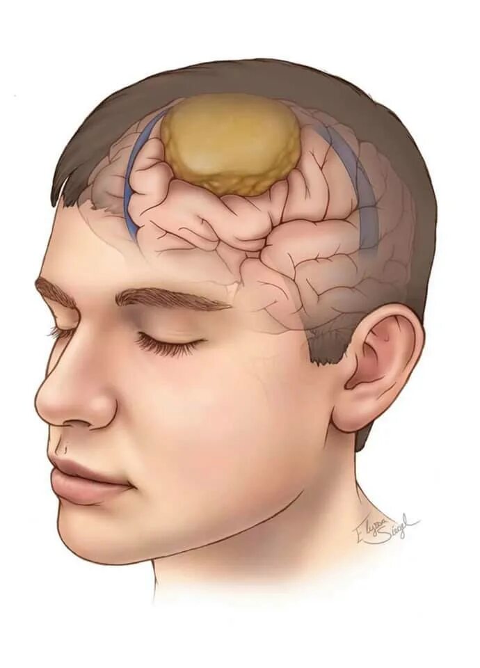 Злокачественное новообразование головного мозга. Доброкачественная опухоль мозга.