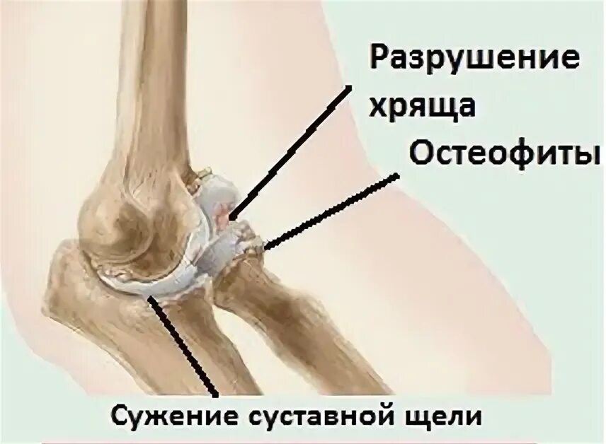 артроз локтевого сустава. остеоартроз локтевого сустава. остеоартроз локтевого сустава. женский локоть. остеоартроз 2 стадии локтевого сустава.