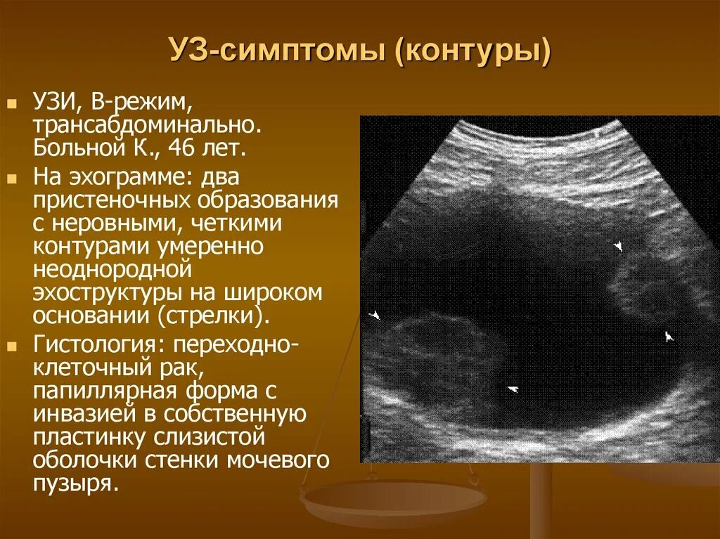 Опухоль карцинома мочевого пузыря. Ультразвуковое исследование (УЗИ) мочевого пузыря. Киста яичника УЗИ трансабдоминальное. Объемное образование мочевого пузыря на УЗИ.