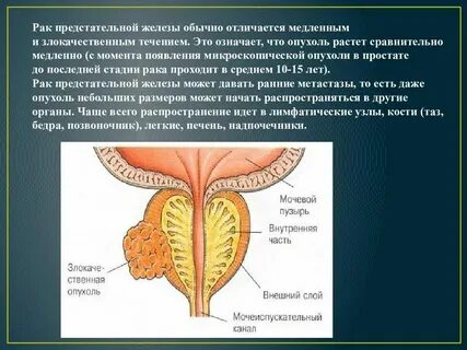Что такое онкология предстательной железы