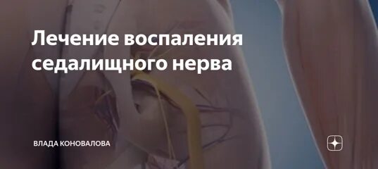 Защемление седалищного нерва от уколов. Воспаление воспаление седалищного нерва. Уколы для седалищного нерва в пояснице. Блокада укол седалищный нерв. Уколы при воспалении седалищного нерва.