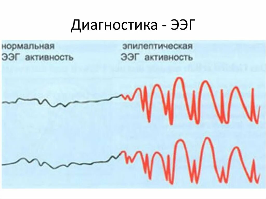 Эпи ээг. Пик волна на ЭЭГ. ЭЭГ здорового человека и эпилептика. ЭЭГ эпилепсия пик-волна. ЭЭГ волны при эпилепсии.