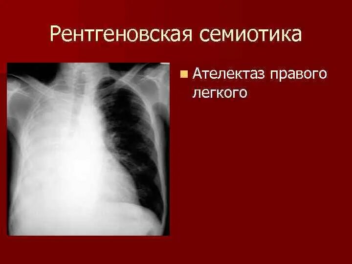 Признаки ателектаза легкого. Компрессионный ателектаз рентген. Компрессионный ателектаз легкого рентген. Пиелектаз рентгенограмма. Обтурационный ателектаз рентген.