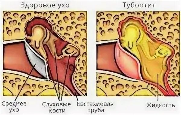 Отит у взрослого симптомы