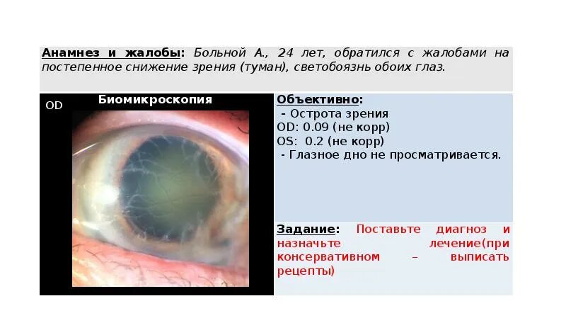 Больно шевелить глазами. Биомикроскопия глазного дна. Биомикроскопия переднего отрезка глаза. Биомикроскопия глаза норма.