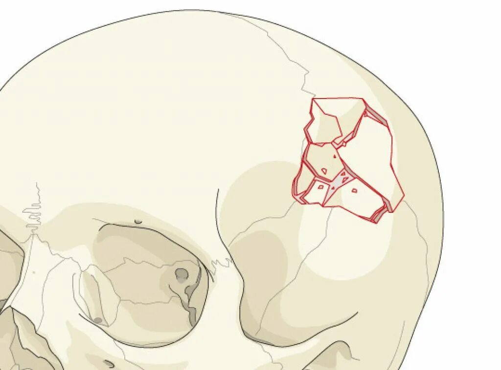 Трещина в голове. Многооскольчатый перелом костей свода черепа. Оскольчатый перелом перелом черепа. Вдавленный перелом костей свода черепа. Оскольчатый перелом основания черепа.