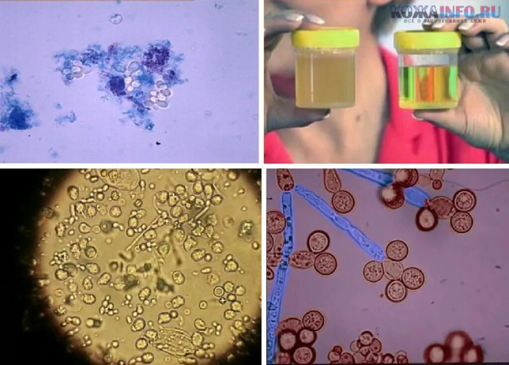 Что значит бактерии в моче у мужчин. Дрожжевые грибы микроскопия мочи. Грибки дрожжевые в микроскопии мочи. Грибок Candida в моче. Грибок в моче микроскопия.