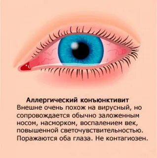 Как избавиться от коньюктивита