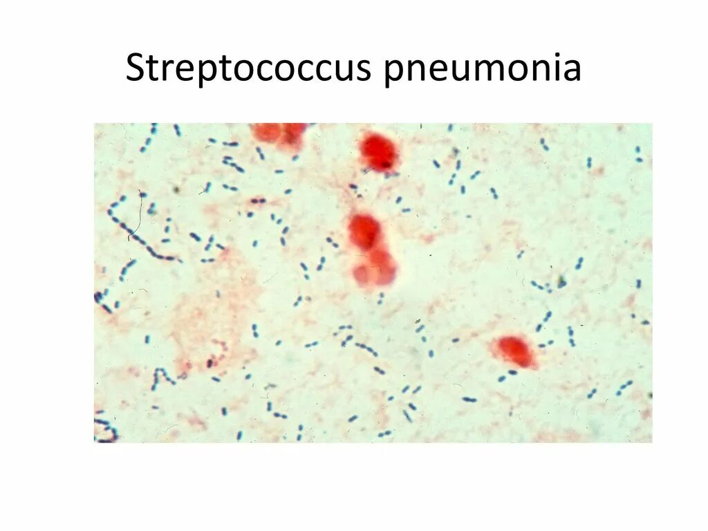 Стрептококк pneumoniae в мазке. Стрептококкус пневмония по Граму. Стрептококк пневмония мазок.