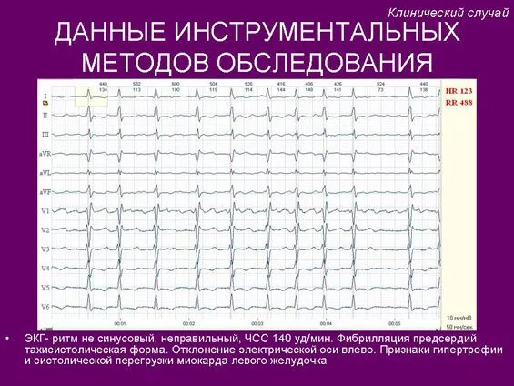 фибрилляция предсердий клинические рекомендации 2022