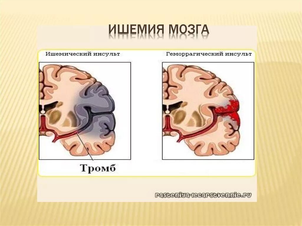 Ишемия состояние. Ишемия мозга. Ишемическое поражение мозга. Ишемия головного мозга симптомы.