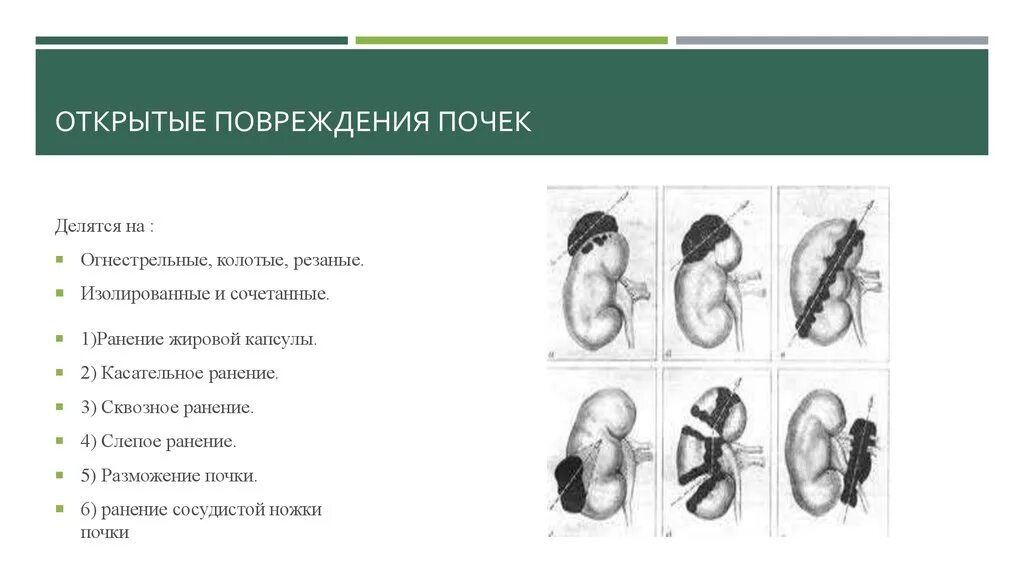 Почечный разрыв