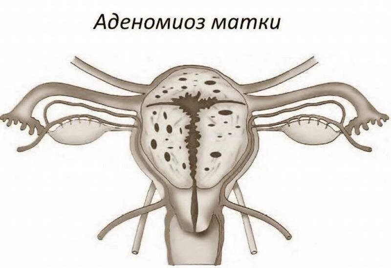 Эхо аденомиоза. Эндометриоз аденомиоз матки. Эхоскопически-аденомиоз.