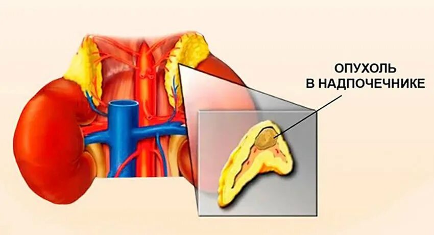 Аденома надпочечника у мужчин что это. Опухоль коры надпочечников. Воспаление надпочечников.