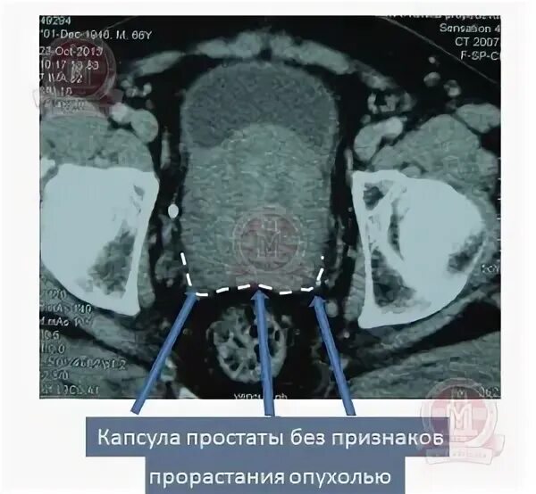 Капсула предстательной железы. Капсула в предстательной железе. Хирургическая капсула предстательной. Хирургическая капсула предстательной железы это. Анатомическая капсула простаты.