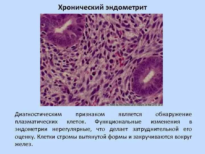 Острый эндометрит гистология. Гипертрофический эндометрит. Хронический эндометрит гистероскопическая картина. Гнойный эндометрит патанатомия.