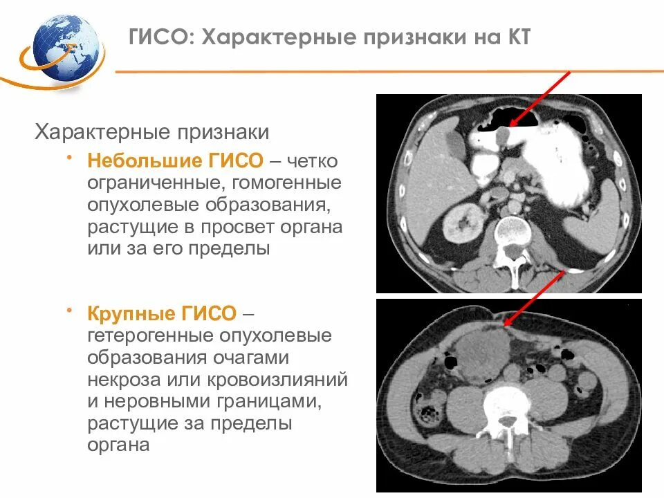 Гастроинтестинальная опухоль