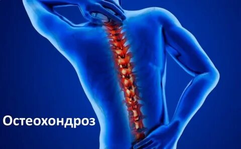 Крестцовая невралгия