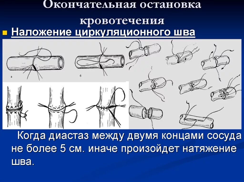 Механические методы окончательной остановки кровотечения рисунки. Способы окончательной остановки кровотечения. Окончательная остановка кровотечения. Физические способы окончательной остановки кровотечения. Какие способы остановки кровотечения наиболее эффективны