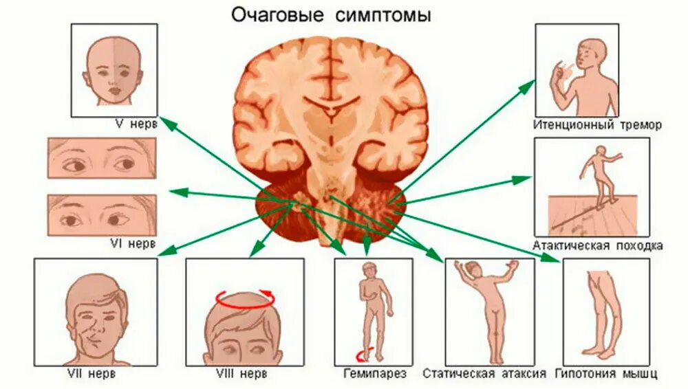 Очаговые симптомы поражения. Очаговая неврологическая симптоматика менингит. Симптомы мозжечковой опухоли. Синдромы при опухолях головного мозга. Клинические симптомы поражения мозжечка.