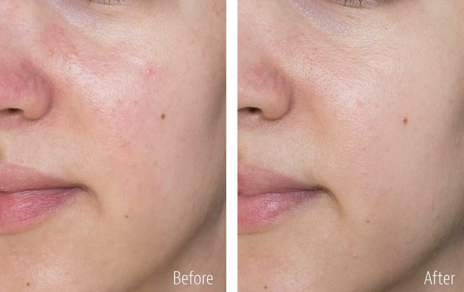 My before. Cleansing face before after.