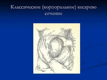 Что такое кесарево сечение у женщин