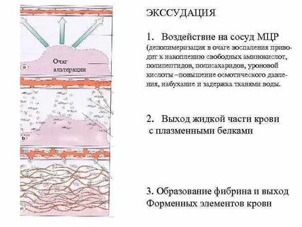 Экссудация