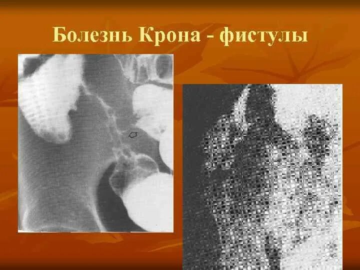 Крона рак. Болезнь крона булыжная мостовая. Булыжная мостовая рентген болезнь крона. Основные синдромы при болезни крона. Крона рак.
