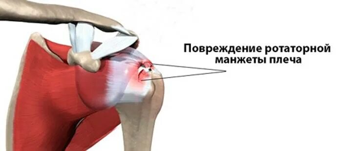 Повреждение сухожилия подлопаточной мышцы. Ротаторная манжета плечевого сустава. Травмы ротаторной манжеты плечевого сустава. Ротаторная манжета разрыв. Ротаторная манжета плечевого сустава анатомия.