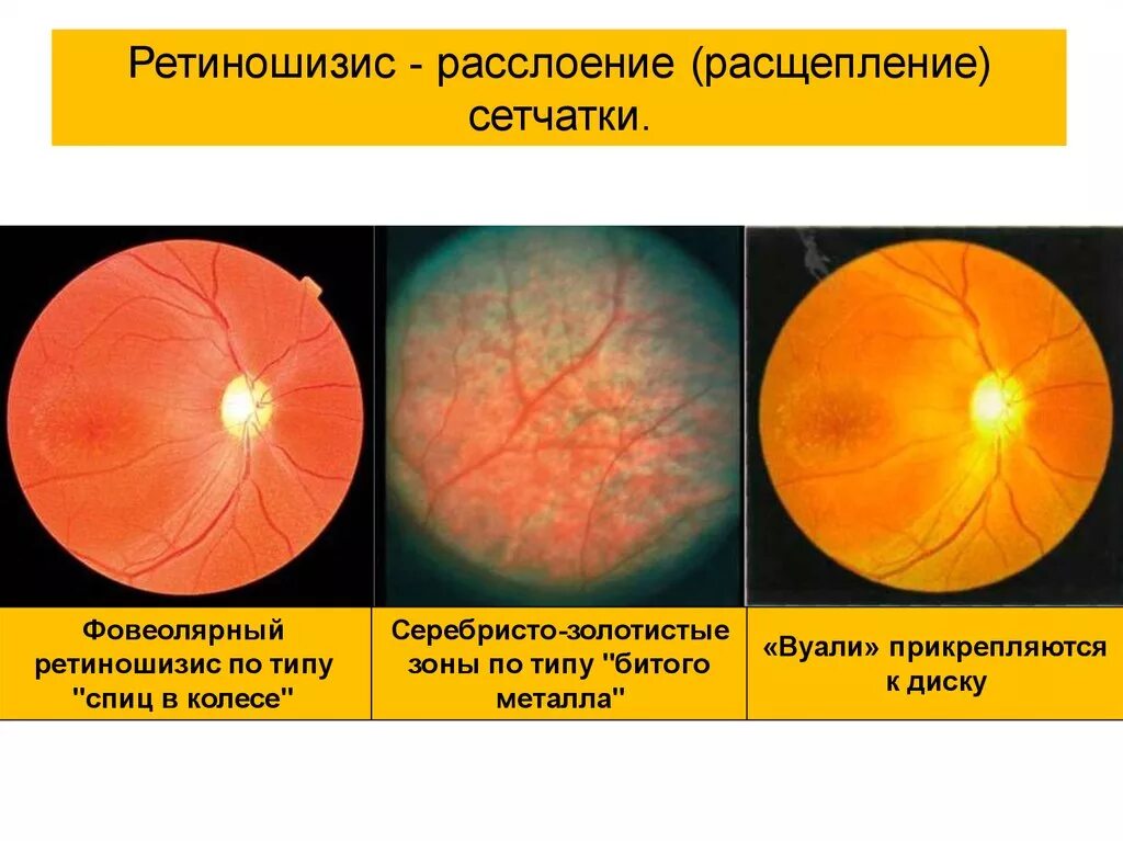 Периферические ретинальные дегенерации. Ретиношизис сетчатки глаза. Кистозный ретиношизис. Тракционная отслойка сетчатки. Отслойка сетчатки офтальмоскопия.